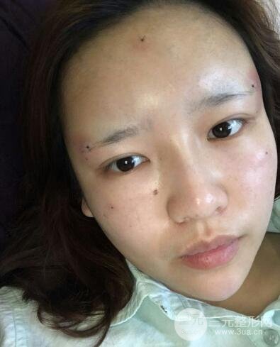 成都嬌點(diǎn)整容醫(yī)院李競(jìng)做全臉脂肪填充案例
