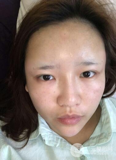 成都嬌點(diǎn)整容醫(yī)院李競(jìng)做全臉脂肪填充案例