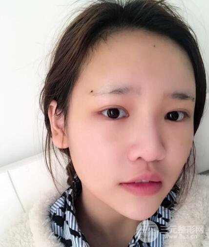 成都嬌點(diǎn)整容醫(yī)院李競(jìng)做全臉脂肪填充案例