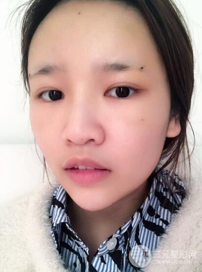 成都嬌點(diǎn)整容醫(yī)院李競(jìng)做全臉脂肪填充案例