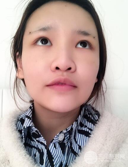 成都嬌點(diǎn)整容醫(yī)院李競(jìng)做全臉脂肪填充案例