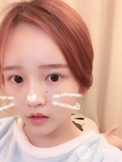 成都嬌點(diǎn)整容醫(yī)院李競(jìng)做全臉脂肪填充案例