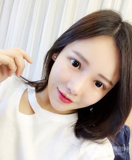 成都嬌點(diǎn)整容醫(yī)院李競(jìng)做全臉脂肪填充案例