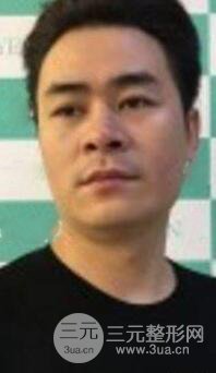 男士高強(qiáng)度聚焦超聲面b提升微整形真實(shí)案例