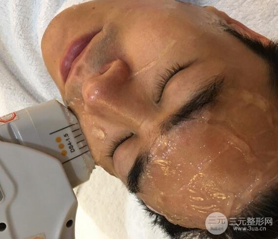 男士高強(qiáng)度聚焦超聲面b提升微整形真實(shí)案例