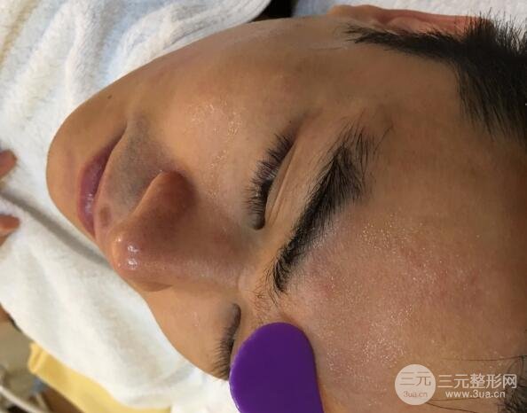 男士高強(qiáng)度聚焦超聲面b提升微整形真實(shí)案例