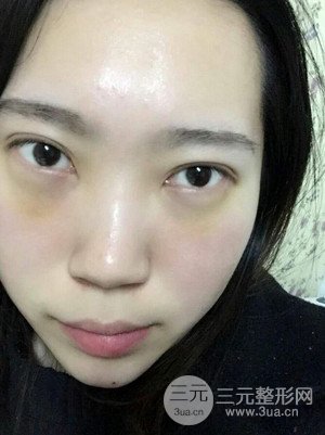 內(nèi)切祛眼袋手術真實案例，武漢天申胡麗醫(yī)生做的