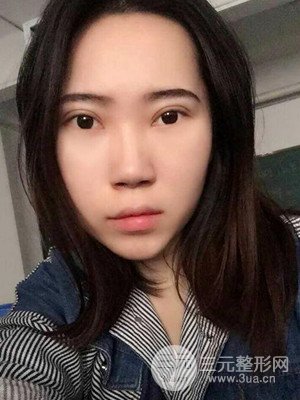 內(nèi)切祛眼袋手術真實案例，武漢天申胡麗醫(yī)生做的
