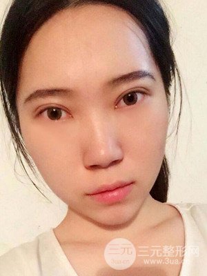 內(nèi)切祛眼袋手術真實案例，武漢天申胡麗醫(yī)生做的