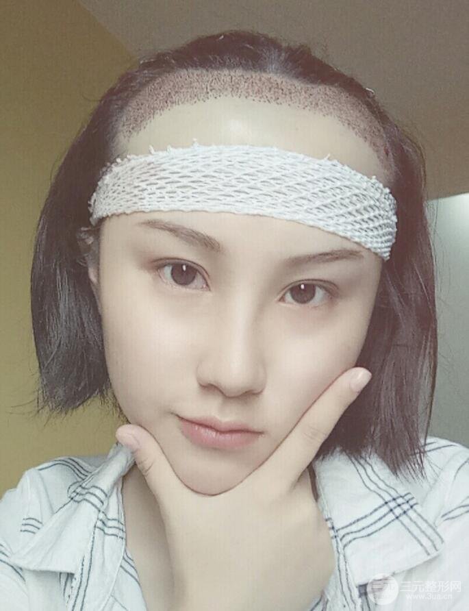 武漢天申胡麗醫(yī)生發(fā)際線種植真實案例，并附上前后對比圖片