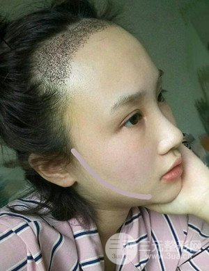 武漢天申胡麗醫(yī)生發(fā)際線種植真實案例，并附上前后對比圖片