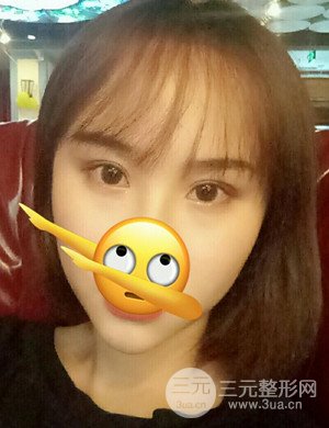 武漢天申胡麗醫(yī)生發(fā)際線種植真實案例，并附上前后對比圖片