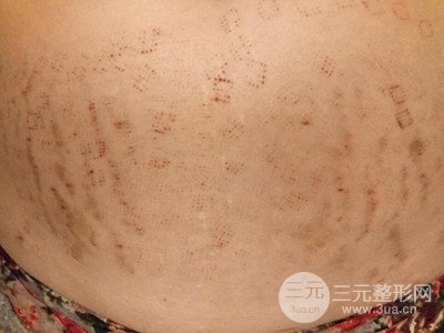 武漢一美王朝暉激光去妊娠紋真實案例，并附上前后對比圖片