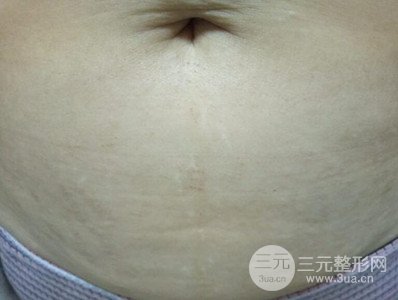 武漢一美王朝暉激光去妊娠紋真實案例，并附上前后對比圖片