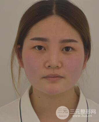 全切開(kāi)雙眼皮價(jià)格和恢復(fù)過(guò)程對(duì)比圖片