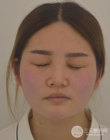 全切開(kāi)雙眼皮價(jià)格和恢復(fù)過(guò)程對(duì)比圖片