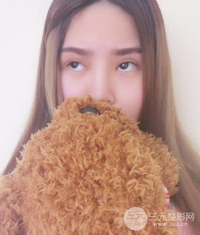 全切開(kāi)雙眼皮價(jià)格和恢復(fù)過(guò)程對(duì)比圖片