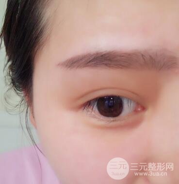 全切開(kāi)雙眼皮價(jià)格和恢復(fù)過(guò)程對(duì)比圖片