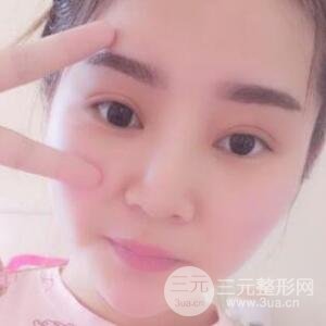 全切開雙眼皮價格和恢復(fù)過程對比圖片