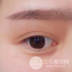 全切開雙眼皮價格和恢復(fù)過程對比圖片