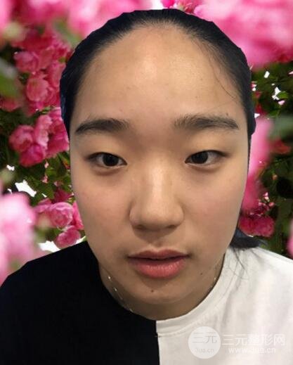 切開(kāi)雙眼皮+開(kāi)眼角+隆鼻多項(xiàng)整形手術(shù)價(jià)格和恢復(fù)過(guò)程圖案例