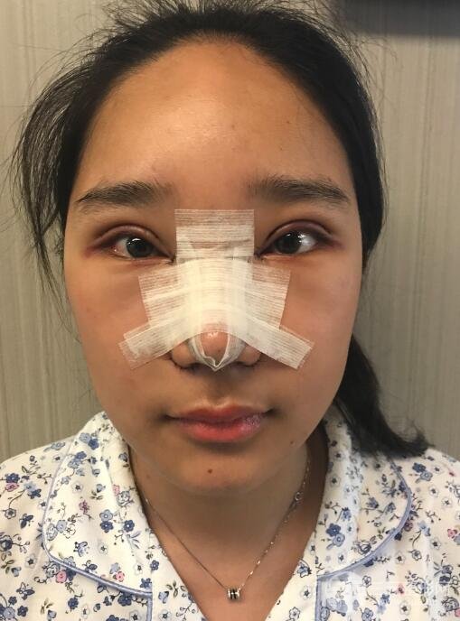 切開(kāi)雙眼皮+開(kāi)眼角+隆鼻多項(xiàng)整形手術(shù)價(jià)格和恢復(fù)過(guò)程圖案例