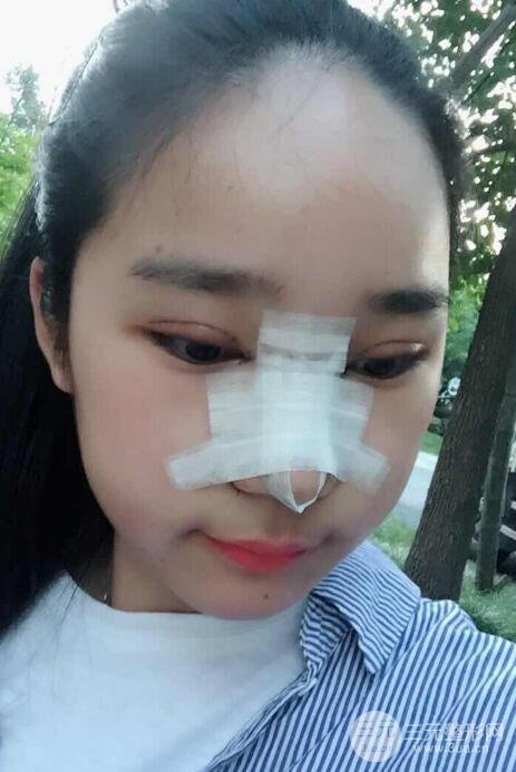 切開(kāi)雙眼皮+開(kāi)眼角+隆鼻多項(xiàng)整形手術(shù)價(jià)格和恢復(fù)過(guò)程圖案例