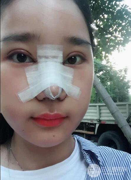 切開(kāi)雙眼皮+開(kāi)眼角+隆鼻多項(xiàng)整形手術(shù)價(jià)格和恢復(fù)過(guò)程圖案例