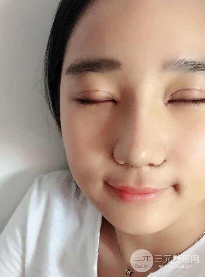 切開(kāi)雙眼皮+開(kāi)眼角+隆鼻多項(xiàng)整形手術(shù)價(jià)格和恢復(fù)過(guò)程圖案例