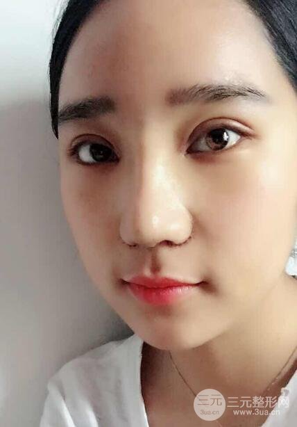 切開(kāi)雙眼皮+開(kāi)眼角+隆鼻多項(xiàng)整形手術(shù)價(jià)格和恢復(fù)過(guò)程圖案例