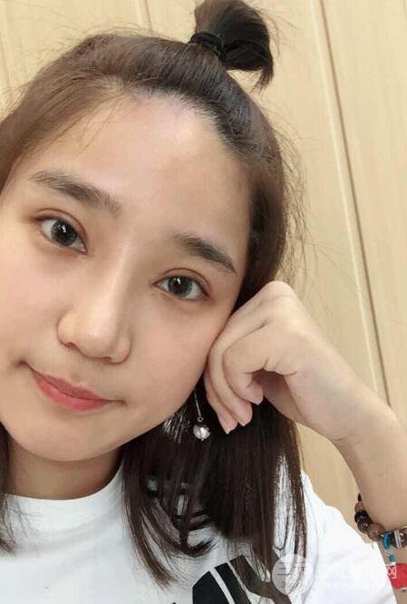 切開(kāi)雙眼皮+開(kāi)眼角+隆鼻多項(xiàng)整形手術(shù)價(jià)格和恢復(fù)過(guò)程圖案例