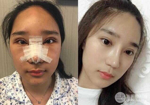 切開(kāi)雙眼皮+開(kāi)眼角+隆鼻多項(xiàng)整形手術(shù)價(jià)格和恢復(fù)過(guò)程圖案例