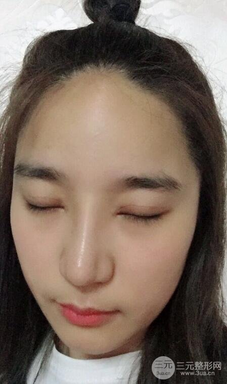 切開(kāi)雙眼皮+開(kāi)眼角+隆鼻多項(xiàng)整形手術(shù)價(jià)格和恢復(fù)過(guò)程圖案例