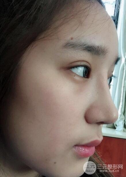 切開(kāi)雙眼皮+開(kāi)眼角+隆鼻多項(xiàng)整形手術(shù)價(jià)格和恢復(fù)過(guò)程圖案例