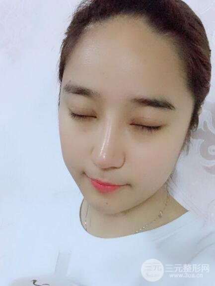 切開(kāi)雙眼皮+開(kāi)眼角+隆鼻多項(xiàng)整形手術(shù)價(jià)格和恢復(fù)過(guò)程圖案例