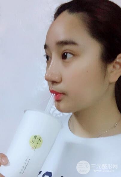 切開(kāi)雙眼皮+開(kāi)眼角+隆鼻多項(xiàng)整形手術(shù)價(jià)格和恢復(fù)過(guò)程圖案例