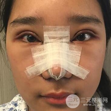 切開雙眼皮+開眼角+隆鼻多項(xiàng)整形手術(shù)價格和恢復(fù)過程圖案例