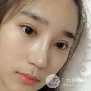 切開雙眼皮+開眼角+隆鼻多項(xiàng)整形手術(shù)價格和恢復(fù)過程圖案例