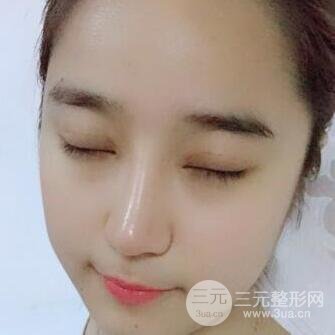 切開雙眼皮+開眼角+隆鼻多項(xiàng)整形手術(shù)價格和恢復(fù)過程圖案例