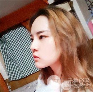 膨體墊下巴術(shù)后一個(gè)月恢復(fù)對(duì)比