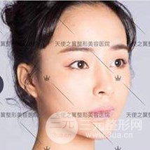 面部自體脂肪填充+隆鼻整形+雙眼皮案例，恢復(fù)果照片~