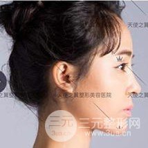 面部自體脂肪填充+隆鼻整形+雙眼皮案例，恢復(fù)果照片~