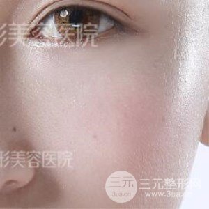 芭比雙眼皮+去眼袋案例分享，還有恢復(fù)過程照片哦~
