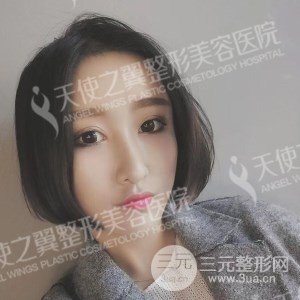 芭比雙眼皮+去眼袋案例分享，還有恢復(fù)過程照片哦~