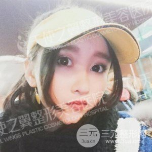 芭比雙眼皮+去眼袋案例分享，還有恢復(fù)過程照片哦~