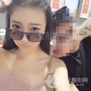 自體脂肪面部填充+全鼻金雕真實(shí)案例，恢復(fù)照片分享~