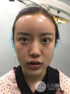 自體脂肪填充額頭+豐下巴真實(shí)案例，昆明都市儷人金海坤醫(yī)生做的