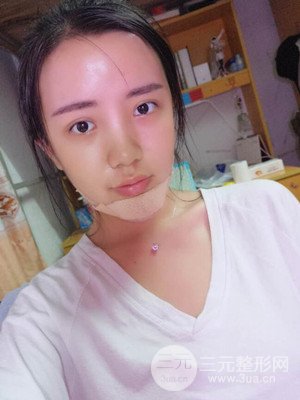 自體脂肪填充額頭+豐下巴真實(shí)案例，昆明都市儷人金海坤醫(yī)生做的