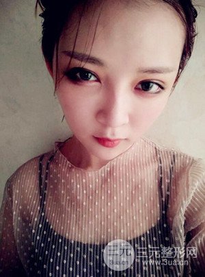 切開雙眼皮+假體隆鼻案例，前后對(duì)比圖分享
