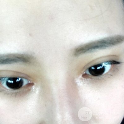 雙眼皮多項(xiàng)整形整形案例：切開雙眼皮+開內(nèi)眼角前后對(duì)比圖